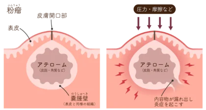 粉瘤とは